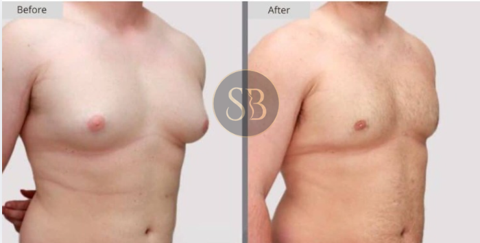 Male Chest Contouring Results - Dr. Sharmistha Bhattacharyya
